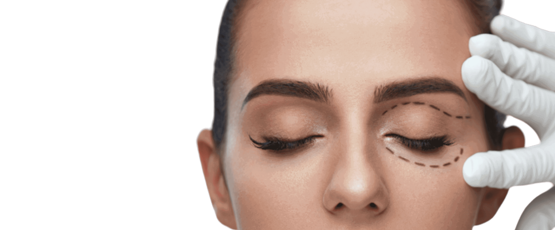 Eyelid surgery