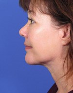 After Neck Correction