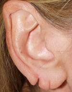 Avant intervention des lobes d'oreille