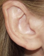 Après intervention des lobes d'oreille