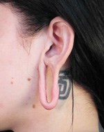 Avant chirurgie des lobes d'oreille