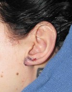 Après chirurgie des lobes d'oreille