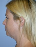 Before Double Chin Liposculpture
