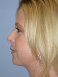 After Double Chin Liposculpture