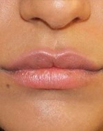 Après augmentation des lèvres par injection de graisse autologue