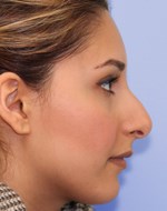 Before refining the nose tip and correction nose bridge