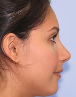 Nach Verfeinerung der Nasenspitze und Korrektur des Nasenrückens