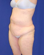 Avant élimination de l'excédent de peau dans la partie supérieure des jambes combinée à un lifting du corps