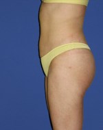 After liposuction under the navel