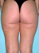 After liposuction of the buttocks