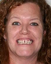 Avant implants dentaires
