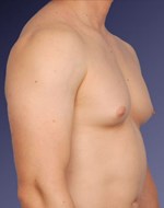 Before Male Breast Reduction 