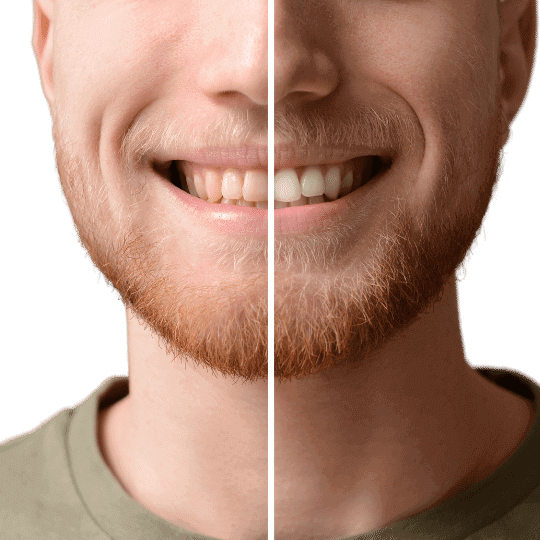 Weiße Zähne: Zahnaufhellung