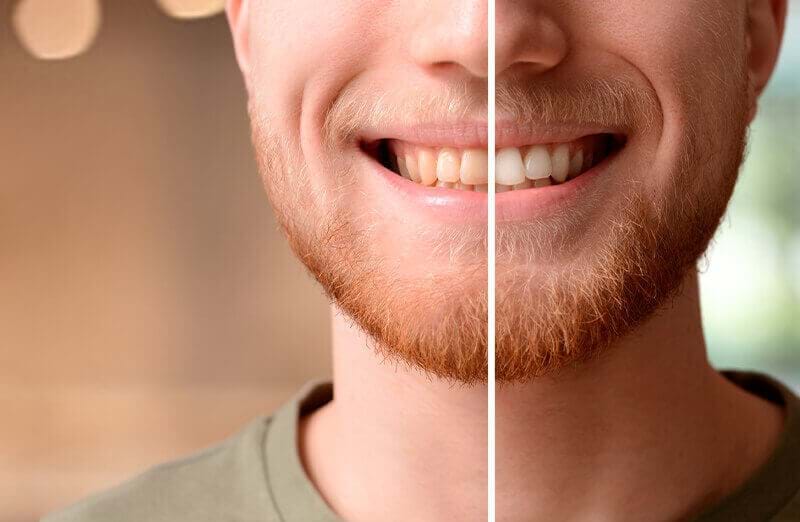 White teeth: dental bleaching