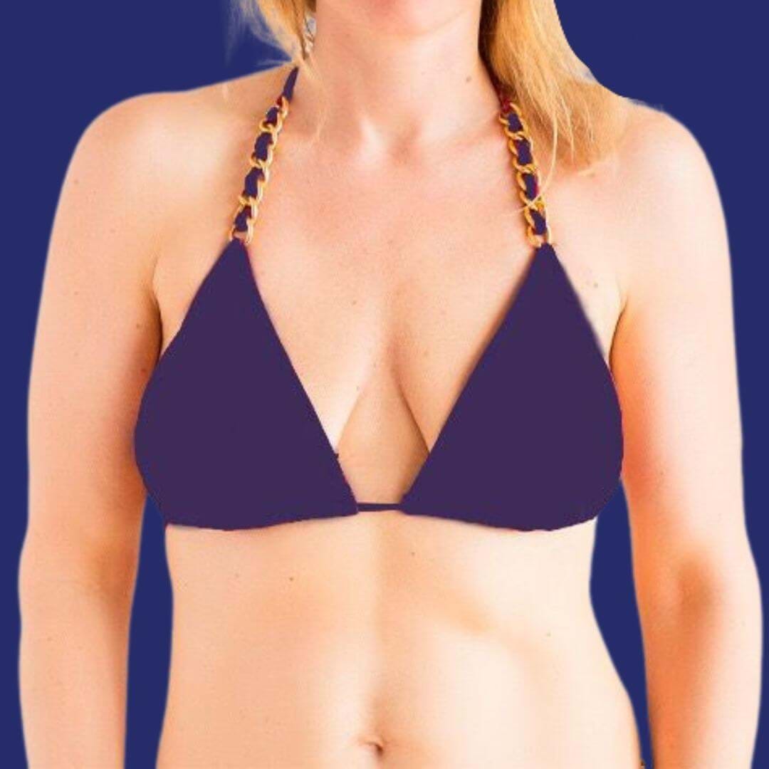 Before breast lift with 380cc HP implants