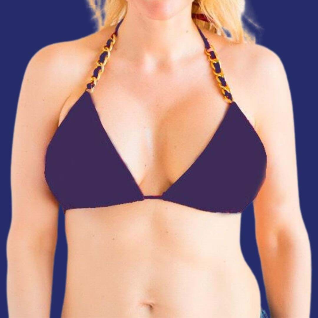 After breast lift with 380cc HP implants