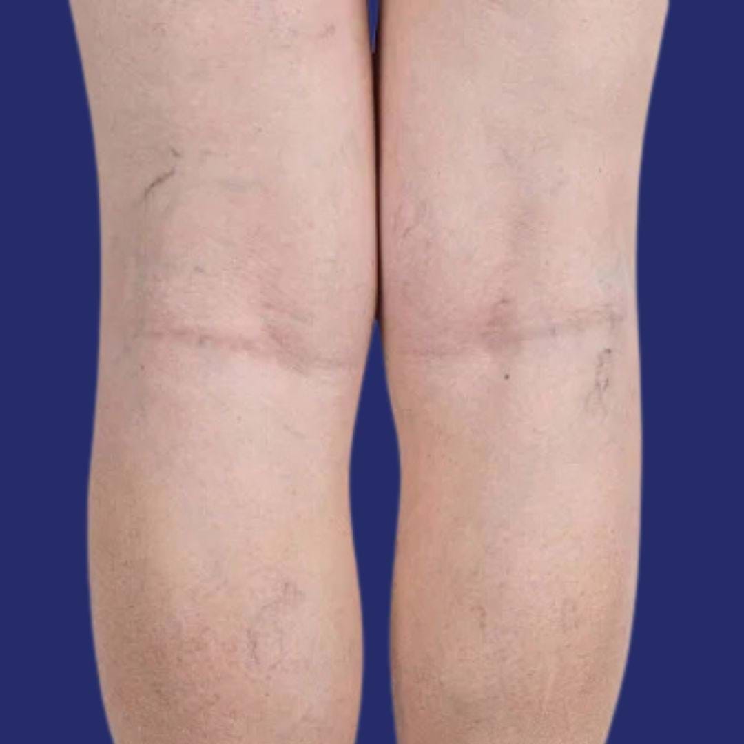 Image de veines saillantes sur les jambes avant traitement vasculaire