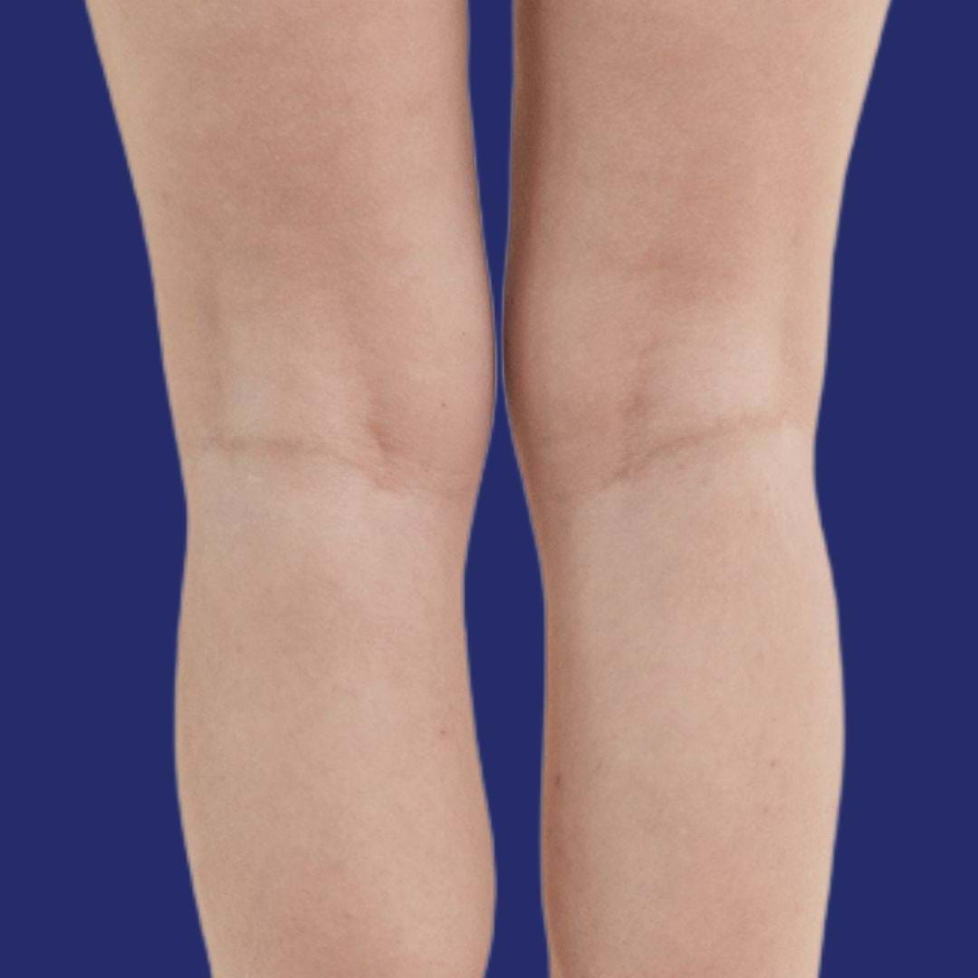 Résultat de jambes plus lisses sans veines visibles après traitement vasculaire