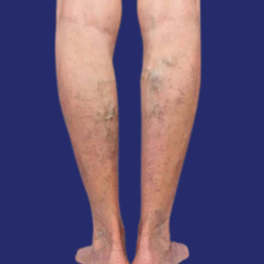 Photograph of varicose veins before the removal procedure