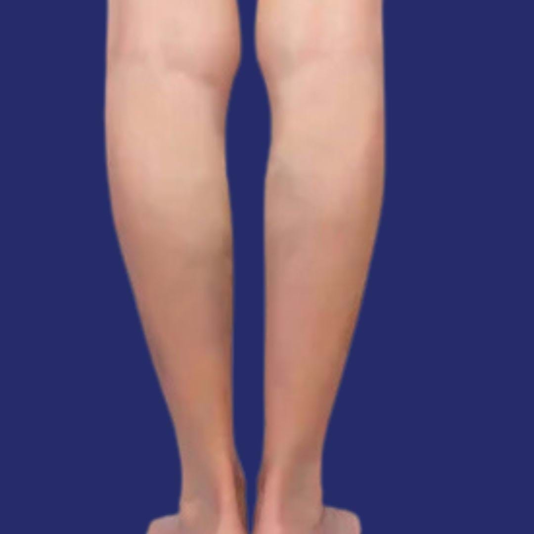Bild von verjüngten Beinen ohne Venen nach dem Eingriff