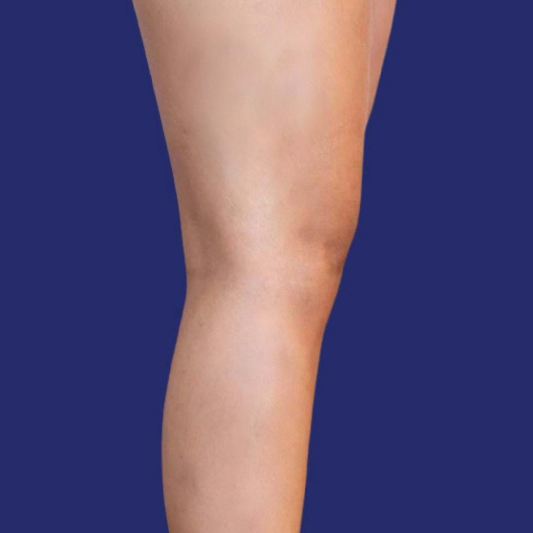 Fotografie von sichtbar verbesserten Beinen nach der Venenentfernung