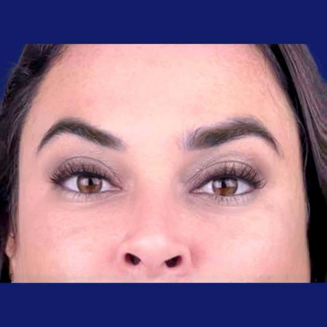 Close-up image of lifted eyebrows post brow lift surgery