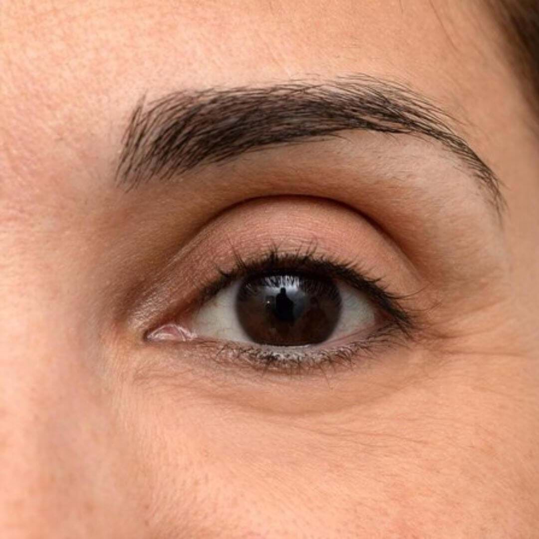 Image showing sagging browline prior to eyebrow lift treatment