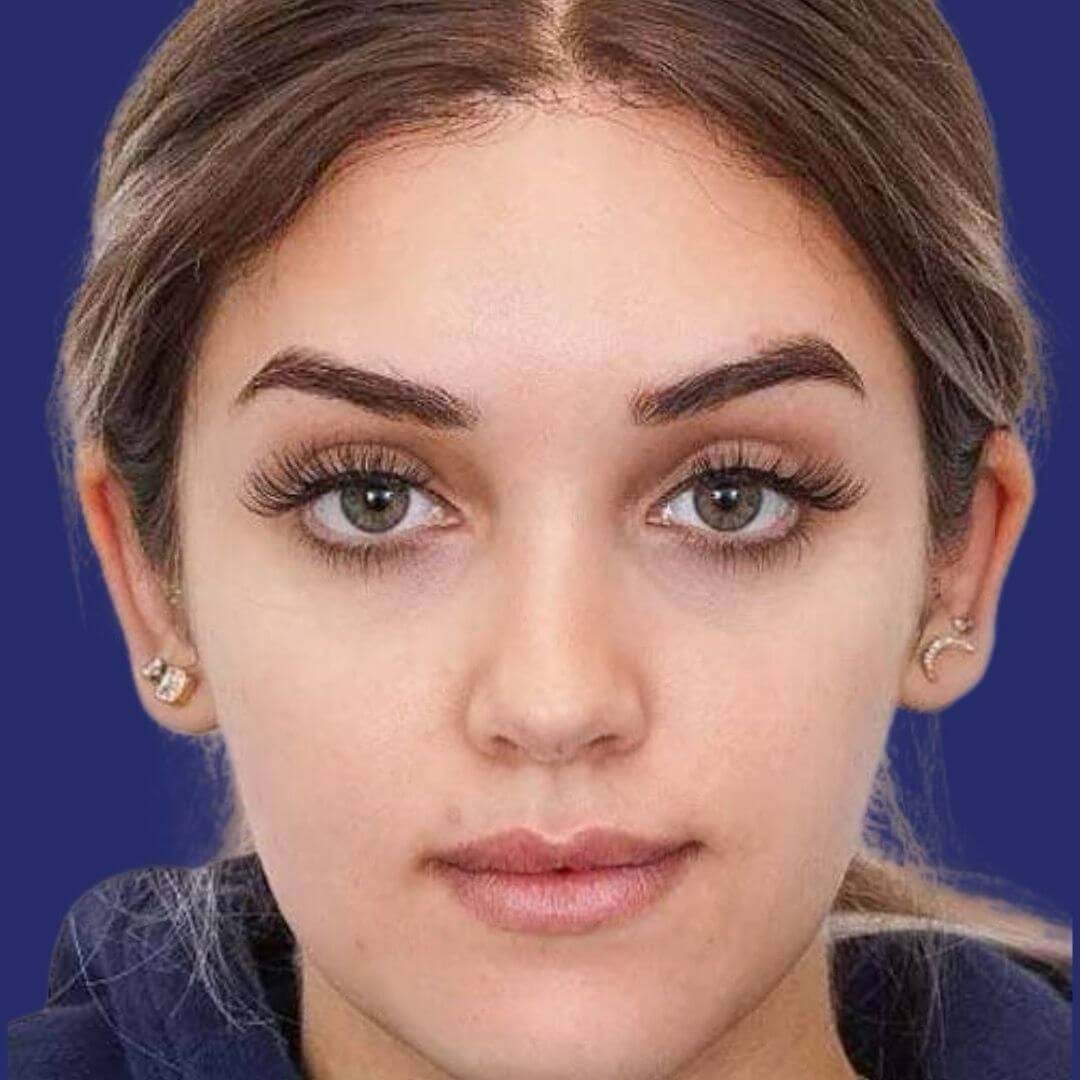 Image showcasing balanced and elevated eyebrows post brow lift procedure