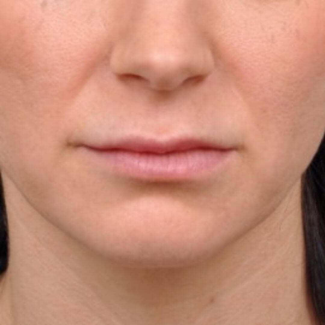 Close-up van lippen vóór de lip-lift-operatie, met subtiele definitie van de bovenlip.