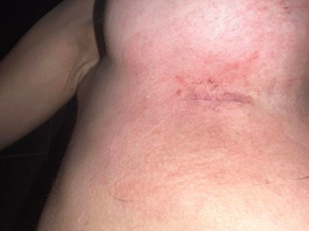 breast enlargement healing