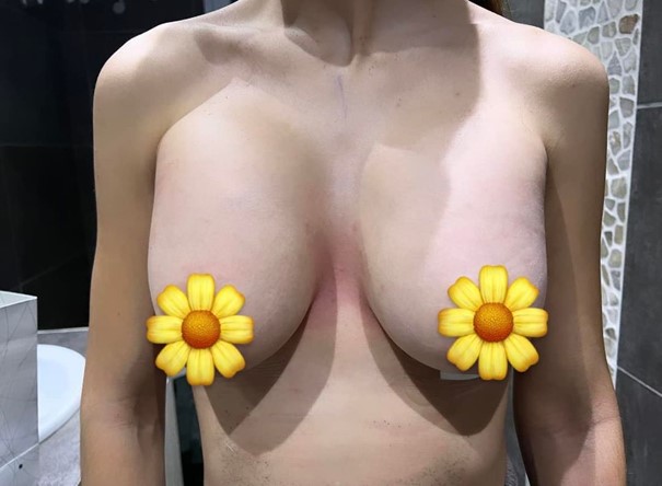 breasts after breast enlargement