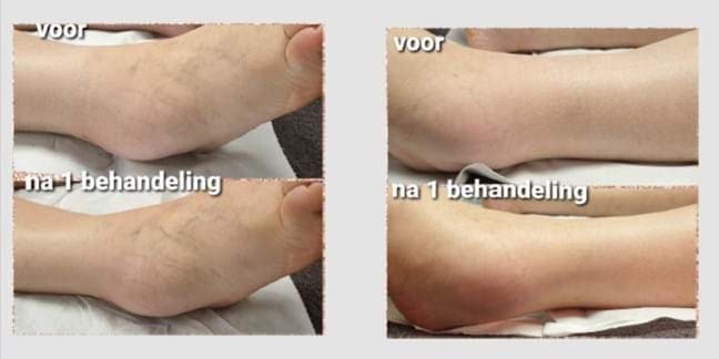 lymfedrainage voor na