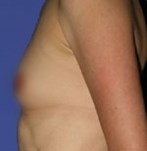 Before breast enlargement with own fat