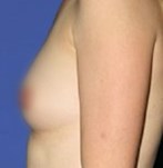 After breast enlargement with own fat