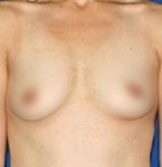 Before natural breast enlargement