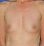Before lipofilling of the breasts