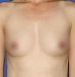 After lipofilling of the breasts