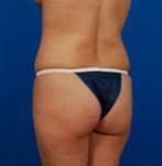 Avant lifting brésilien des fesses Brazilian butt lift