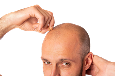 Hair transplant