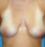 Hängende Brüste vor der Operation