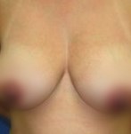 Before breast reduction surgery