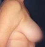 Before breast reduction surgery
