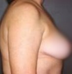 After breast reduction surgery