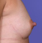 Nipples before corrective surgery