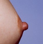 After nipple correction surgery