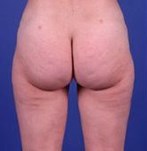 After liposuction of hips and thighs