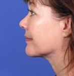 After Neck Correction
