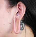 Avant chirurgie des lobes d'oreille