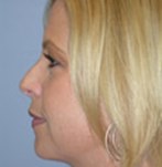 After Double Chin Liposculpture