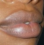 Vor der Lippenverkleinerung